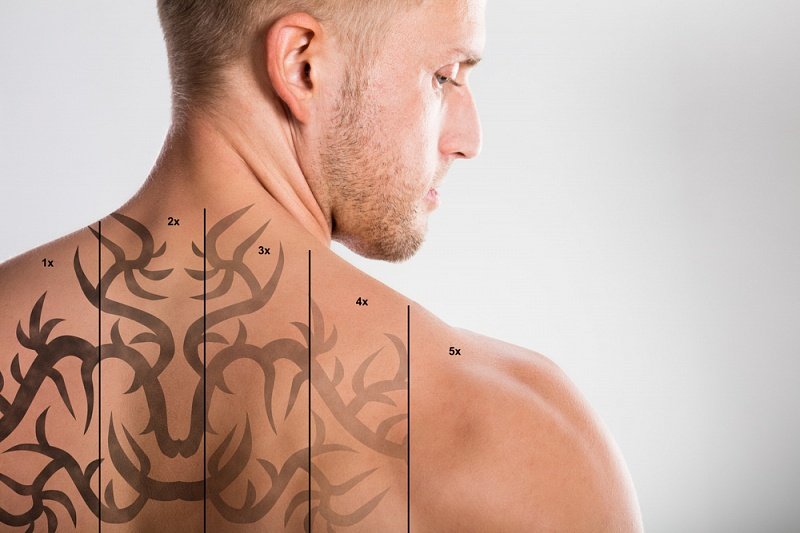 Tattoo and Semi Permanent Makeup Removal Bootle | Radiance Aesthetics & Beauty Liverpool Tattoo and Semi Permanent Makeup Removal Bootle | Radiance Aesthetics & Beauty Liverpool